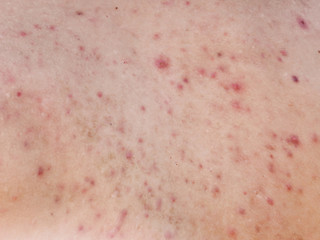 Fototapeta premium Man with acne on his back