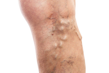Closeup of patient leg with vascular issues