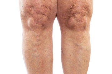 Fototapeta na wymiar Legs with varicose veins