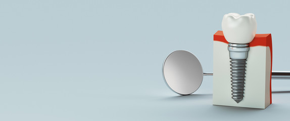 Dental care, dental implant, 3d rendering