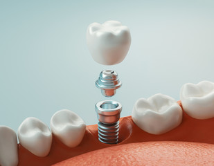 Dental care, dental implant, 3d rendering - obrazy, fototapety, plakaty