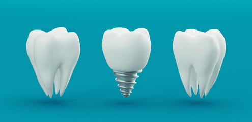 Dental care, dental implant, 3d rendering
