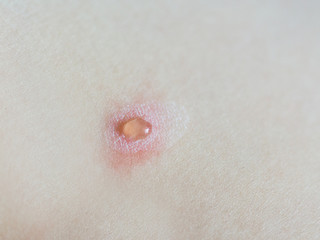 close up of chickenpox 