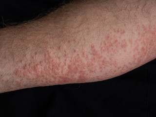 Symptoms of contact allergy on hand’s skin. Close up of hives.