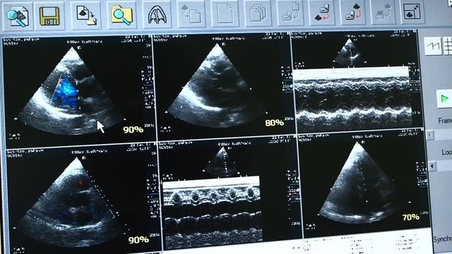 Monitor showing Transthoracic two-dimensional color Doppler echocardiography set of patterns.