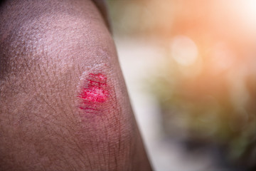 Fototapeta premium Knee wound from fall and bleeding