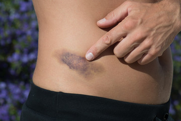 Detail of big bruise on man body