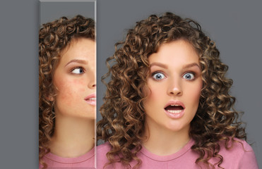 Post-Acne Marks /Treating Acne Scars.Acne Scar Removal