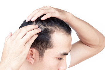 Fototapeta premium Young man serious hair loss problem for health care medical and shampoo product concept