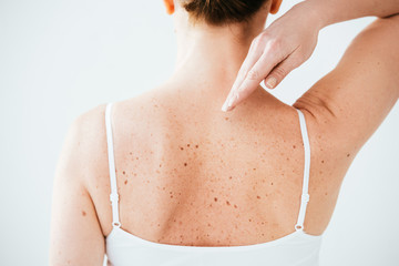 back view of diseased woman with melanoma on skin isolated on white