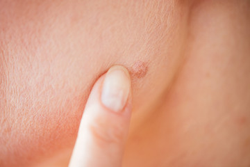 cropped view of woman pointing with finger at mole on skin