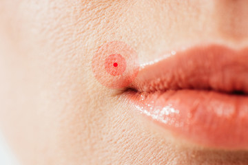 cropped view of herpes on lips of sick woman