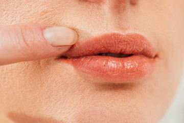cropped view of sick woman touching herpes on lips