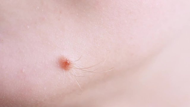  Close-up of hairy skin mole (nevus) on the skin of face. Problem Skin. Macro Video.