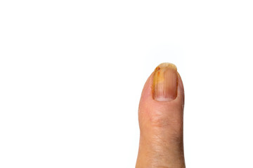 finger  with fungus nail