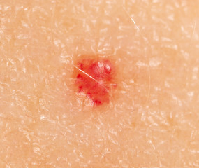 Birthmark on human skin.