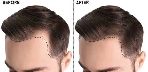 Young man before and after hair loss treatment against white background, closeup - obrazy, fototapety, plakaty