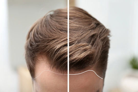 Young man before and after hair loss treatment against blurred background, closeup