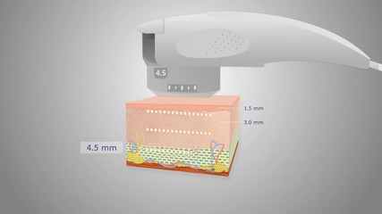 High intensity focused ultrasound.Body care lifting solution.Tools ultrasonic skin and cell.Ultrasonic breaks cells explainer video