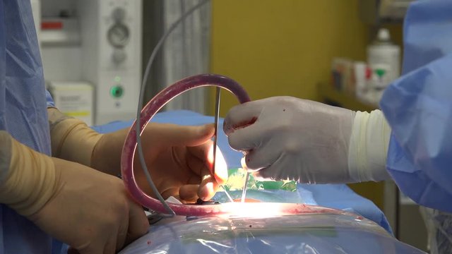 Minimally invasive spine surgery, also known as MISS, has no specific meaning or definition. Basically, it is marketing language that implies a lack of severe invasion, that may or may not be the case