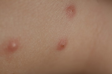 insect bites on  skin  child
