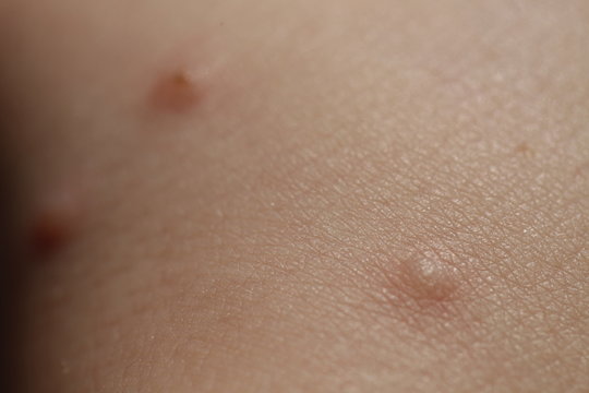 insect bites on  skin  child