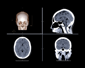 CT brain trauma comparison 3D rendering image , sagittal , axial and coronal view for screening...