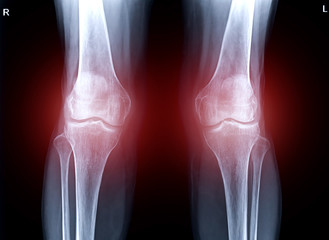 x-ray image of  both knee AP view show Osteoarthritis Knee or OA Knee .