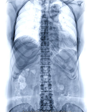 X-ray image of T-L spine or thoracolumbar spine AP view for diagnosis back pain.