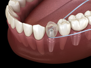 Fototapeta na wymiar Implant tooth cleaning with dental floss. Medically accurate 3D illustration
