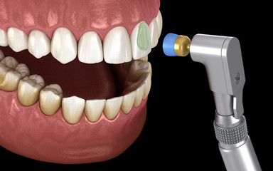 Teeth polishing procedure with professional brush and gel. Medically accurate 3D illustration