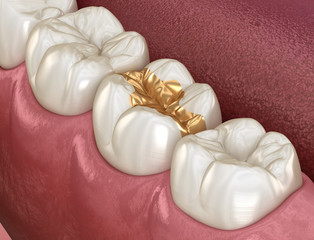 Fototapeta na wymiar Golden Inlay crown fixation over tooth. Medically accurate 3D illustration of human teeth treatment
