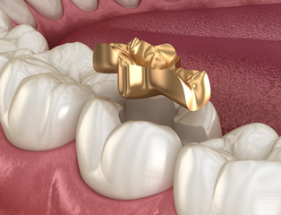 Fototapeta na wymiar Golden Inlay crown fixation over tooth. Medically accurate 3D illustration of human teeth treatment
