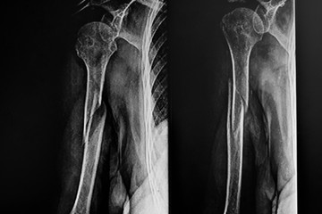 X- Ray of Right humerus bone fracture - obrazy, fototapety, plakaty