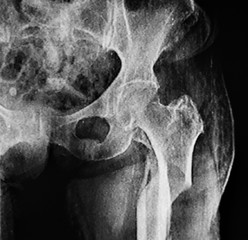 X- Ray of left hip and coxofemoral articulation