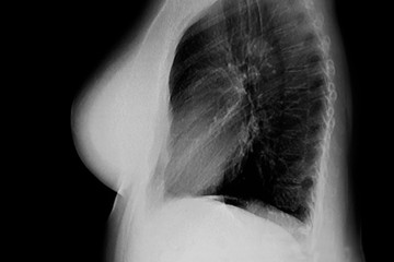 Lateral Chest X- ray that shows a breast prosthesis