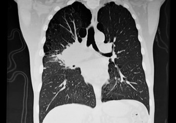 Right Hilum Lung Tumor