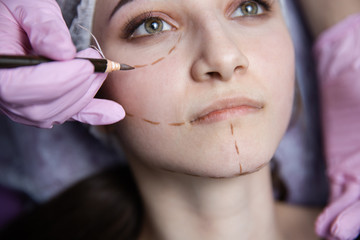 Preparation for plastic surgery. Young model in the clinic with perforation lines on her face