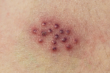 Virus on the body. Rash of Shingles on the skin. Bright red blisters of zoster. Smallpox Disease.