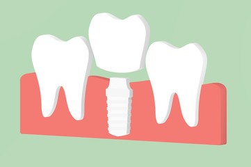 dental implant, installation process and change of teeth - tooth cartoon 3d render