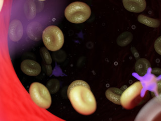 3d rendered medically accurate illustration of diseased blood cells