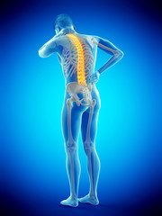 3d rendered medically accurate illustration of man having a backache