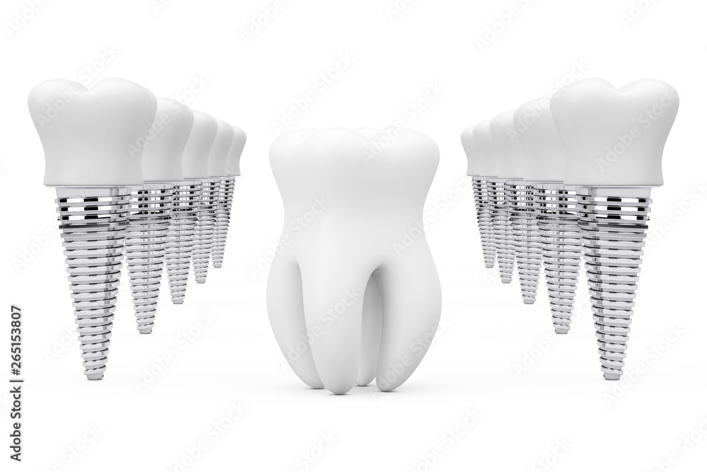 Poster premolar healthy tooth between rows of tooth implants. 3d rendering
