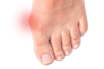 Foot of a woman with painful Hallux Valgus