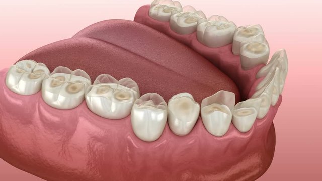 Dental attrition (Bruxism) resulting in loss of tooth tissue.  Medically accurate tooth 3D animation