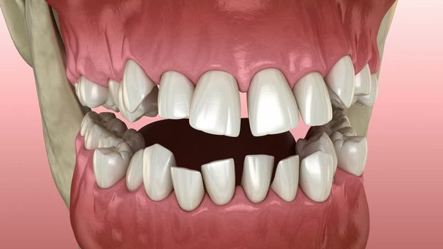Abnormal teeth position, orthodontic concept. Medically accurate tooth 3D animation