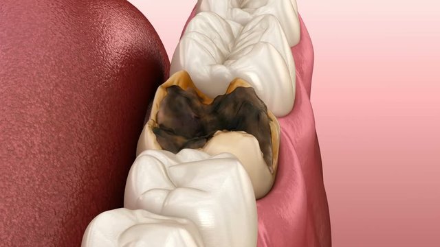 Molar teeth damaged by caries. Medically accurate tooth 3D animation.