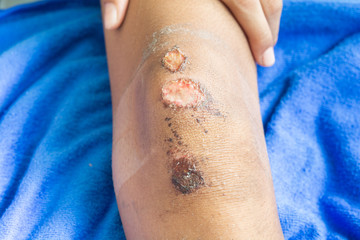 Lesions and knee injuries. Lesions from accident