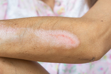Wounds and arm injuries. Lesions from accident