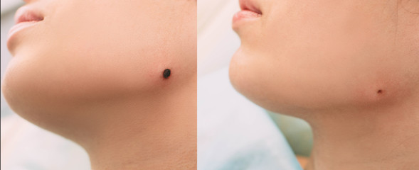 skin area ,before and after mole radio wave electrocoagulation removing. Part of series mole...